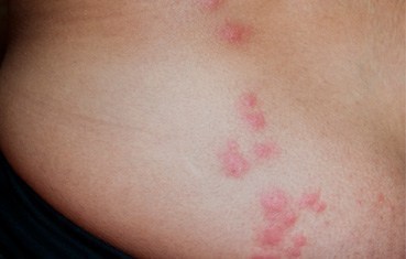 Pictureof Typical Bed Bug Bites. They areCaused by An Allergic ...