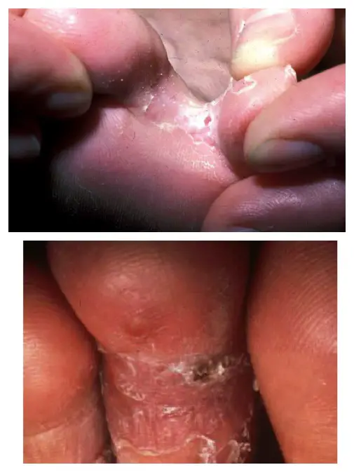 athlete's foot pictures