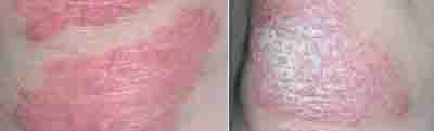 Psoriasis pictures