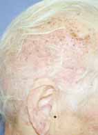 scalp conditions pictures