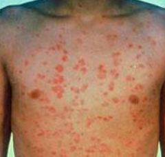 guttate psoriasis baby skin rash