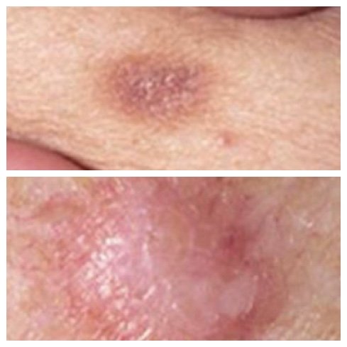 dermatofibroma brown skin spots