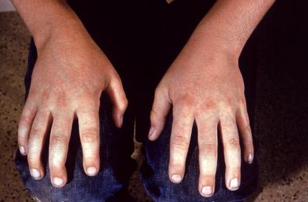 Fifth Disease Rash - Example 1 - 374px x 271px