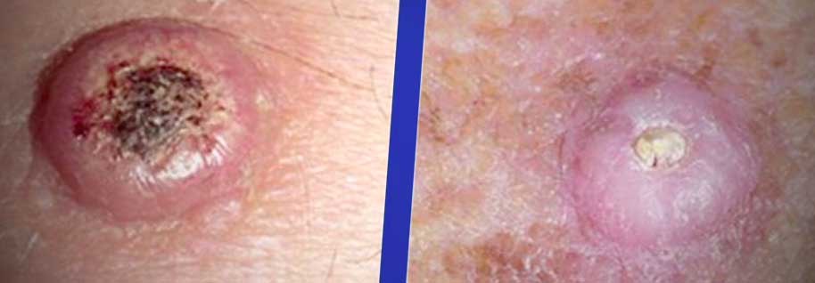 brown spot in mole