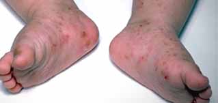 scabies rash on babies